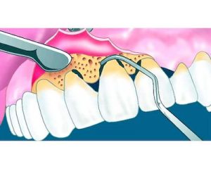 cirugia periodontal