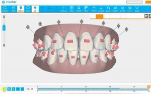 ortodoncia invisalign