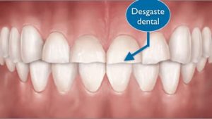 Carillas dentales de composite