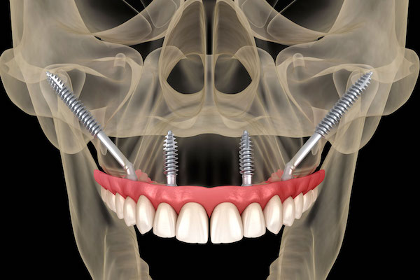 implantes cigomáticos