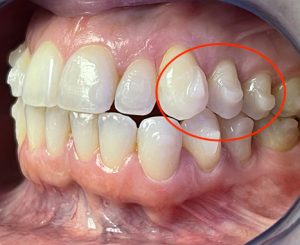 ortodoncia invisalign