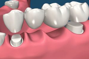 precio puente dental 