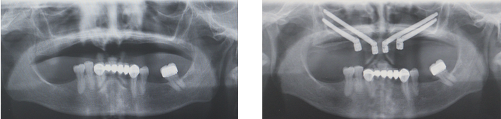 implantes cigomáticos