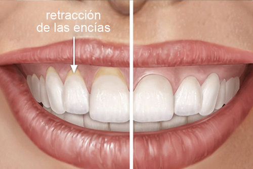 injerto de encía