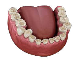 desgaste dental