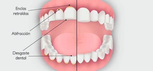desgaste dental