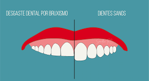desgaste dental