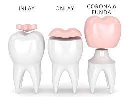 fundas dentales