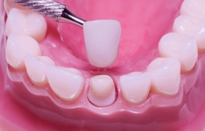 fundas dentales
