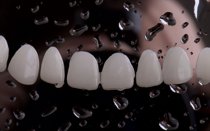 ¿Cuál es el precio de las carillas dentales en 2023?