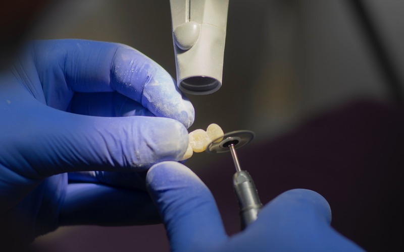 Puente dental fijo: qué es y cuáles son sus principales ventajas