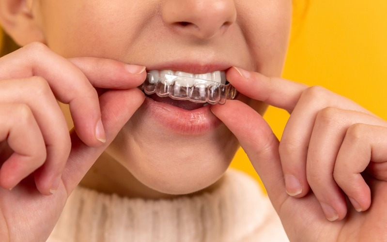 Mejores marcas de ortodoncia invisible