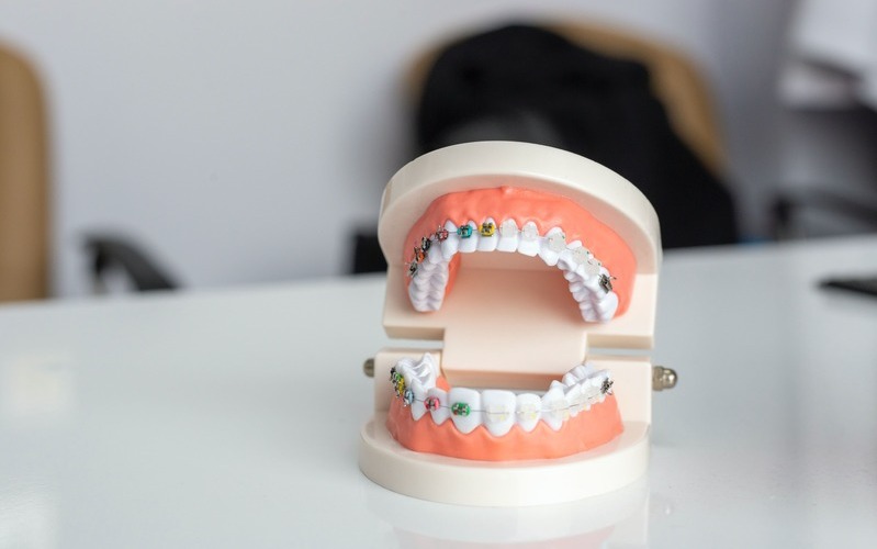 Tratamiento de ortodoncia para corregir la sonrisa gingival