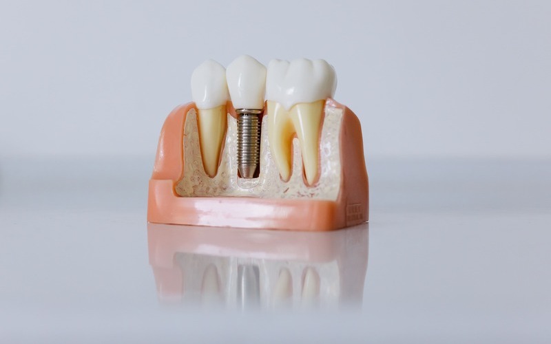 ¿Qué es la osteointegración de los implantes dentales?
