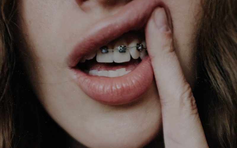 Dientes torcidos: causas y tratamientos para corregirlos
