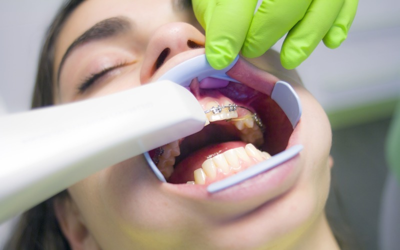 ¿Qué es el escáner intraoral y para qué sirve?