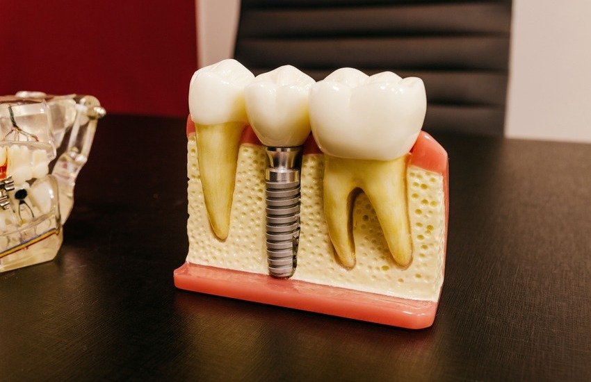 Agenesia dental: qué es, por qué se produce y cómo se trata