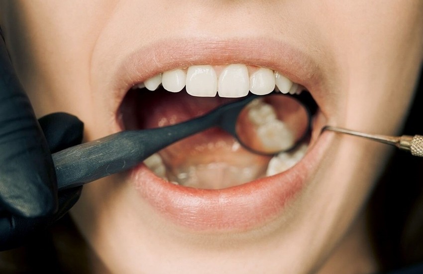 Blanqueamiento dental en casa con férulas: ¿cómo se hace? ¿Es efectivo?